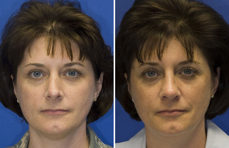 Patient 3 revision rhinoplasty left middle third collapse from prior hump reduction