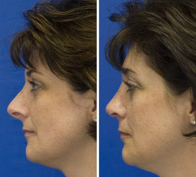 Revision rhinoplasty patient 3 upturned nose repaired with revision rhinoplasty