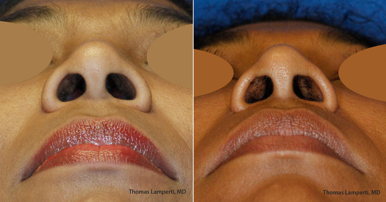 African-Dominican rhinoplasty nostril reduction Base View