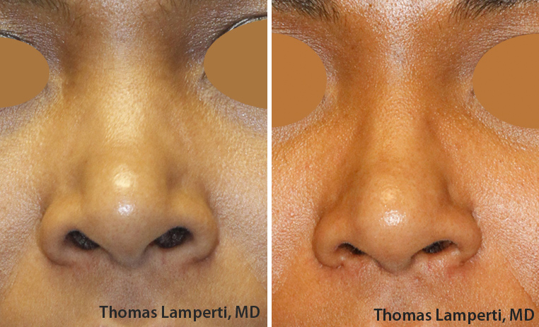 African-Dominican rhinoplasty nostril reduction Frontal View