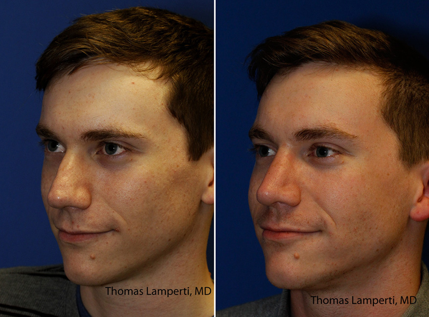 Patient 43 before and after alar base wedge excision rhinoplasty to reduce alar lobule and nostril thickness.jpg