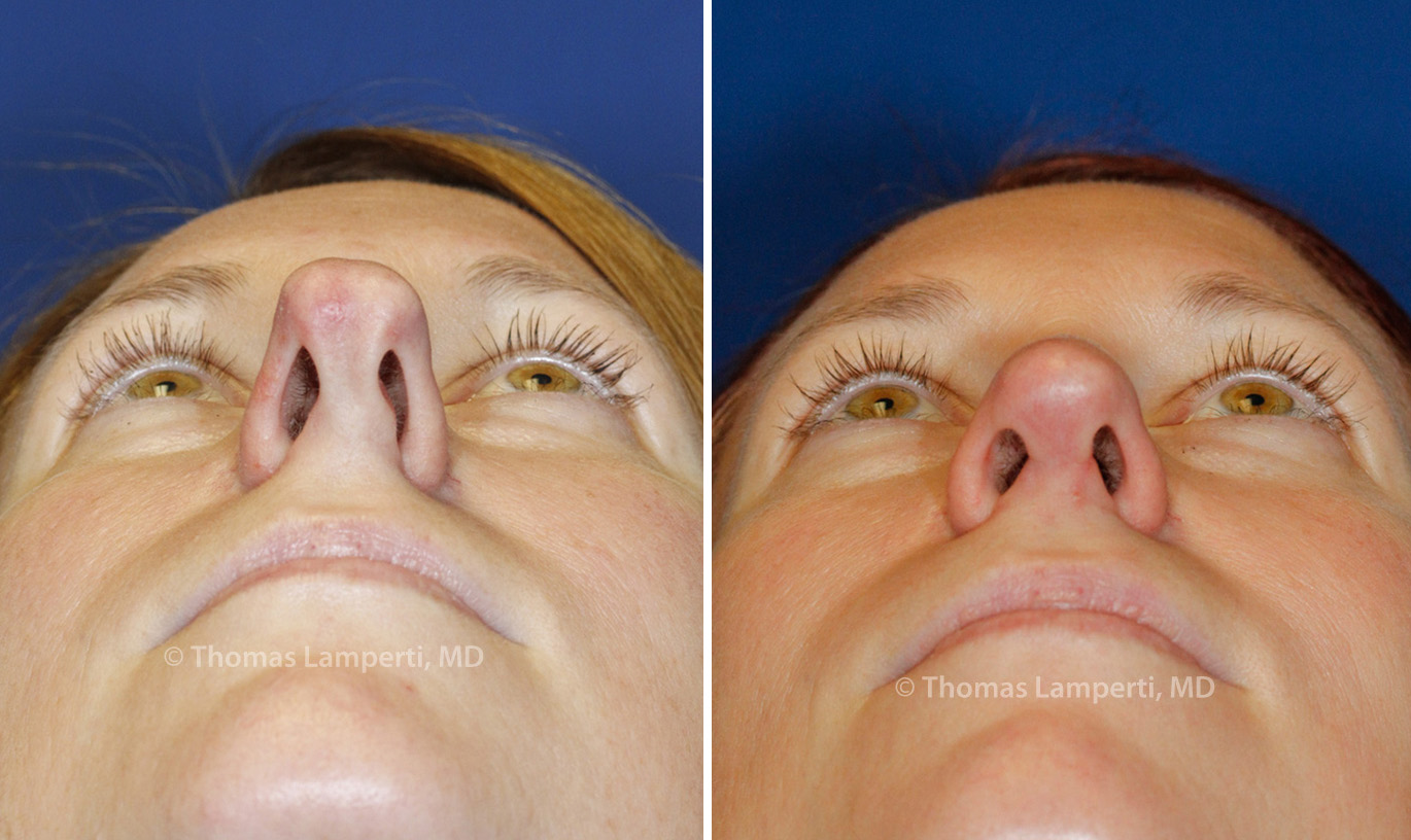Rhinoplasty patient 44 base before and after boxy tip repair