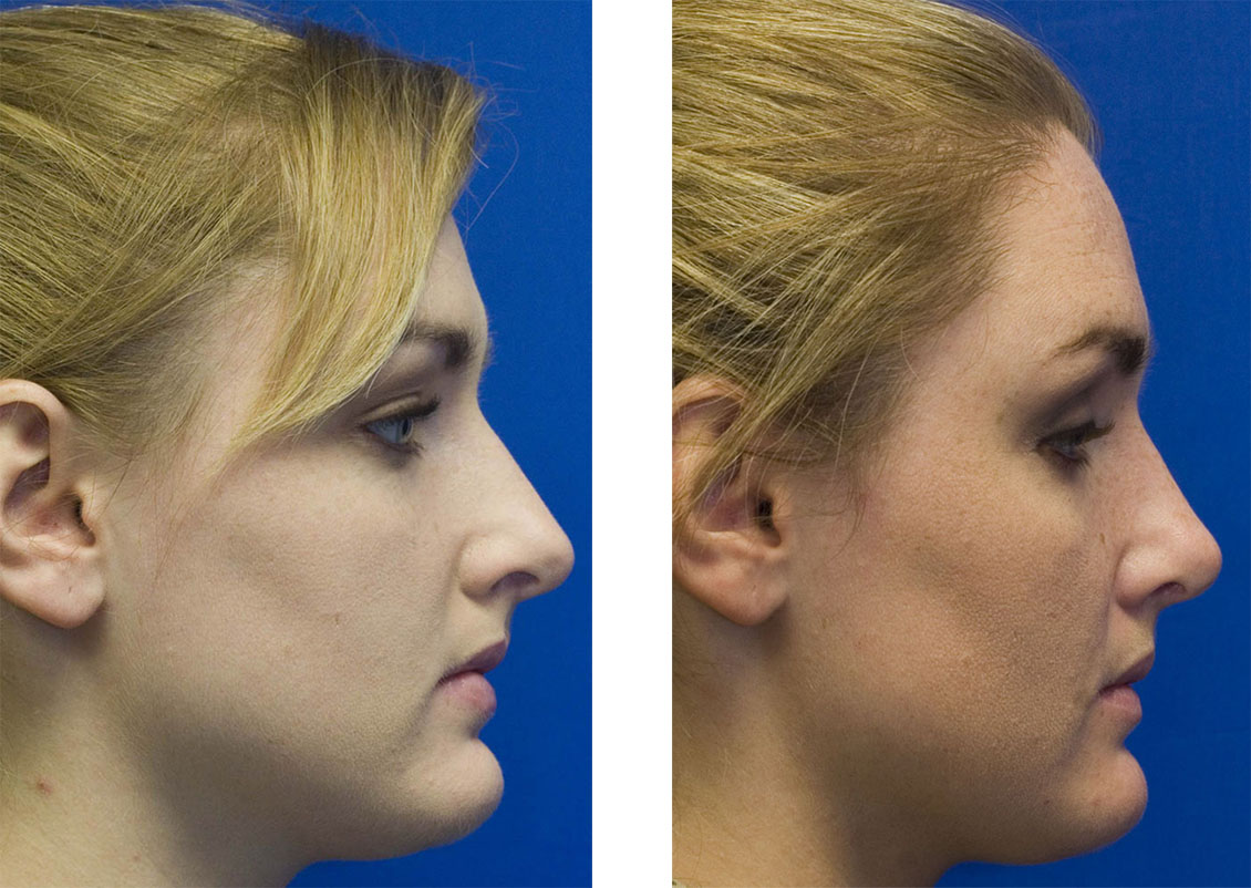 Patient 5 over projected nose rhinoplastu