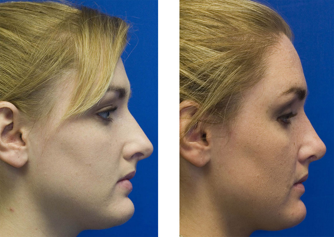 Hanging Columella | Rhinoplasty in Seattle | Rhinoplasty Surgeon