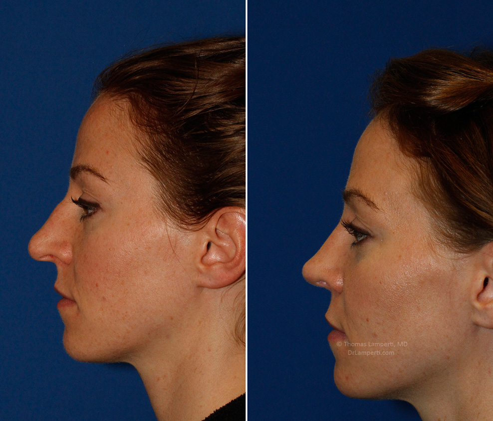 Patient 53 droopy tip rhinoplasty before and after