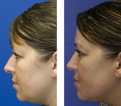 Patient 6 over-projected nose profile
