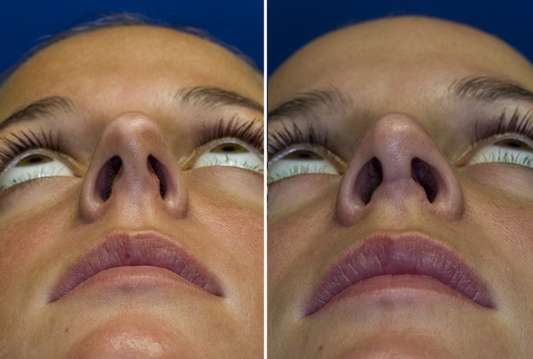 Asymmetric Nostrils Rhinoplasty In Seattle