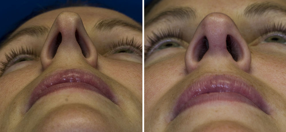 Asymmetric nostril length and size repair