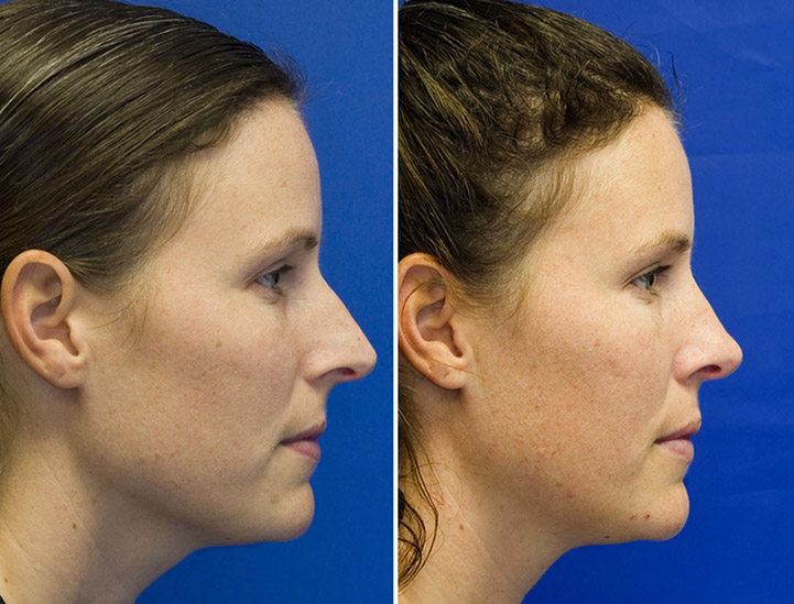 Patient 8 long over-projected nose profile