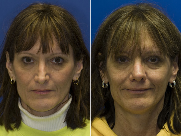 Revision rhinoplasty patient 5 frontal