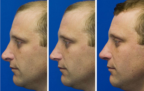 Revision rhinoplasty patient 4. Middle pane shows Dr. Lamperti's preoperative morphing simulation