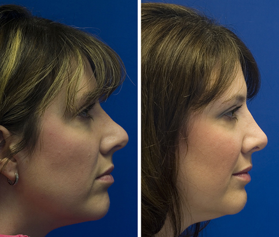 Revision rhinoplasty patient 2 over-projected nose repair