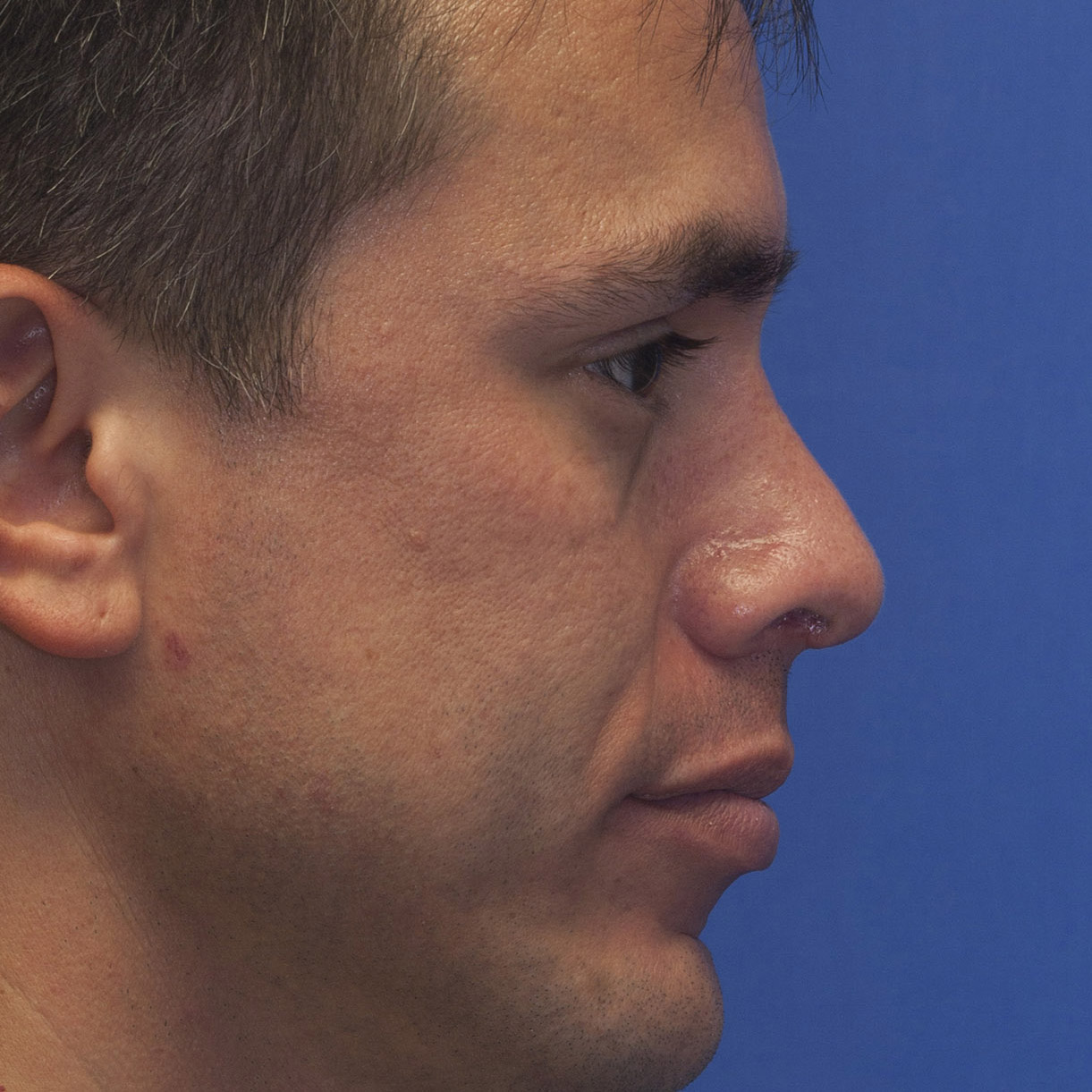 Revision rhinoplasty showing treatment of pollybeak deformity using cartilage grafting