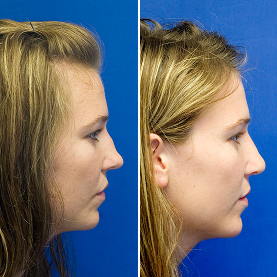 Post-traumatic saddle nose deformity before and after repair