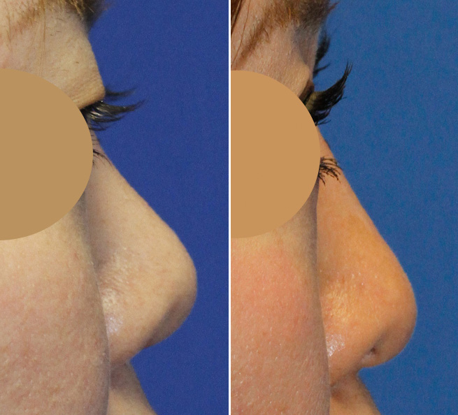 What is Upturned Nose Rhinoplasy?