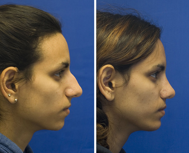 Combined Indian rhinoplasty and chin implantation