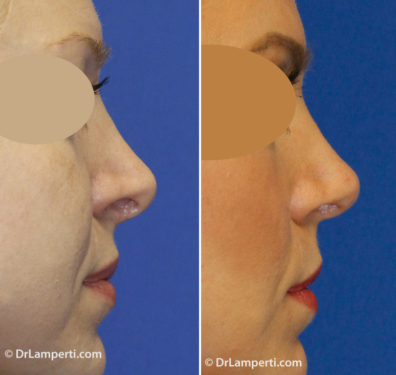 Revision rhinoplasty before and after showing hanging columella and alar retraction repair