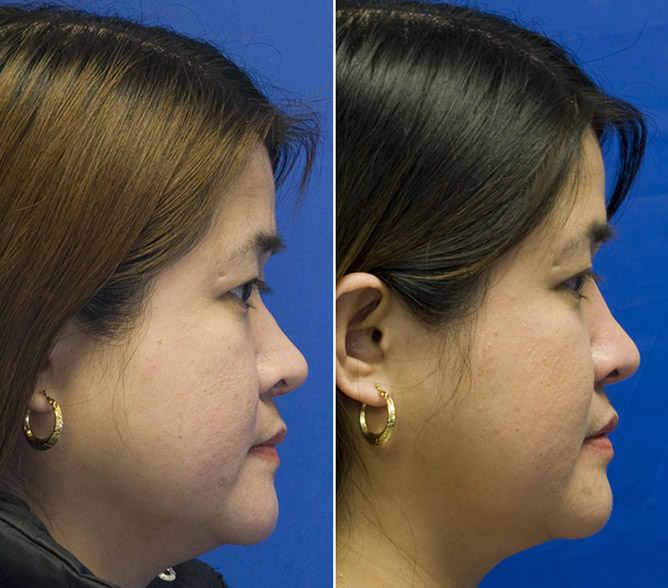 Asian bridge augmentation with layered septal cartilage graft