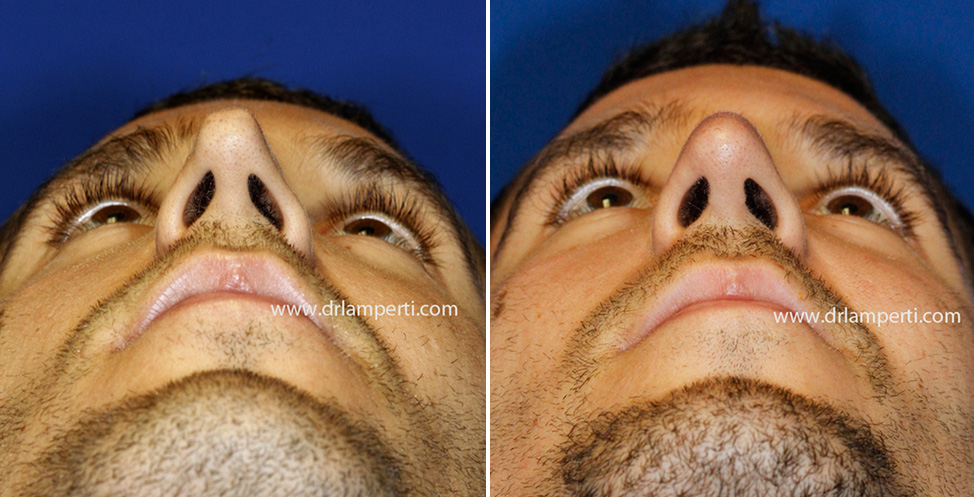 Revision rhinoplasty patient 11 asymmetric nostril repair base view