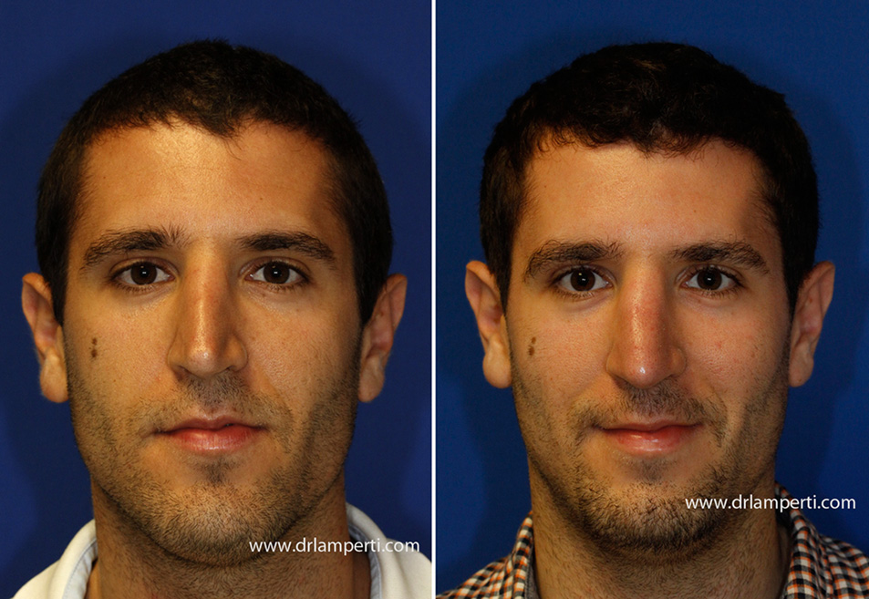 Revision rhinoplasty patient 11 pinching invetsed V nose repair frontal