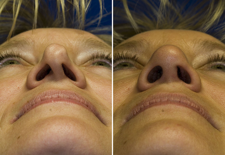 Revision rhinoplasty severe nostril asymmetry repair