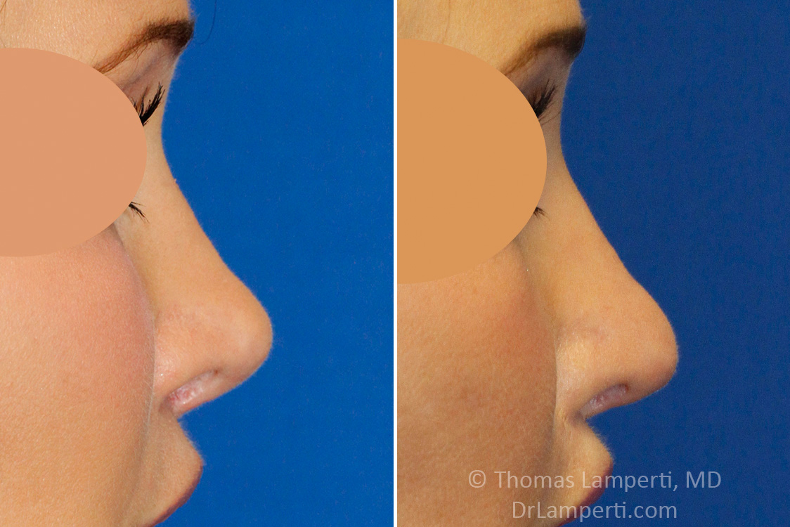 Revision rhinoplasty patient 17 right profile short nose repair