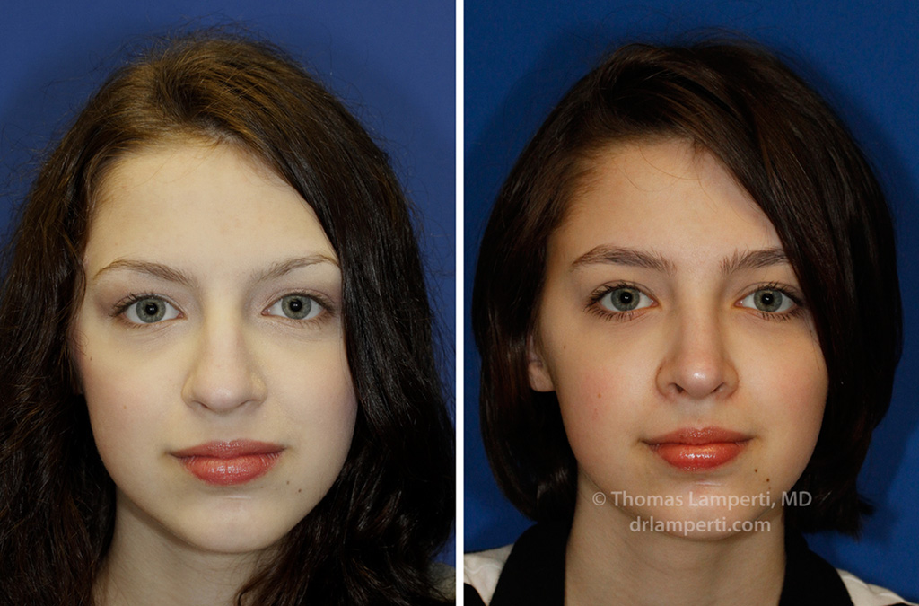 Rhinoplasty patient 45 frontal before and after showing bulbous nose repair