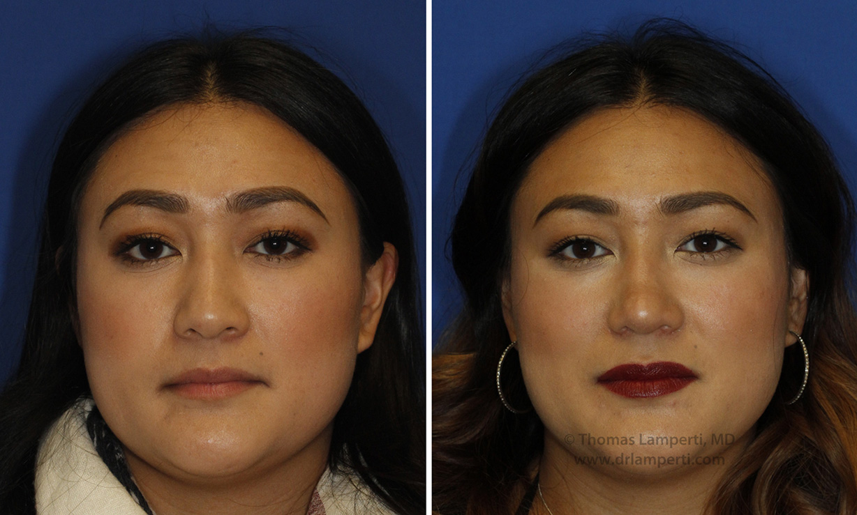 Patient 47 nostril reduction and tip defatting before and after