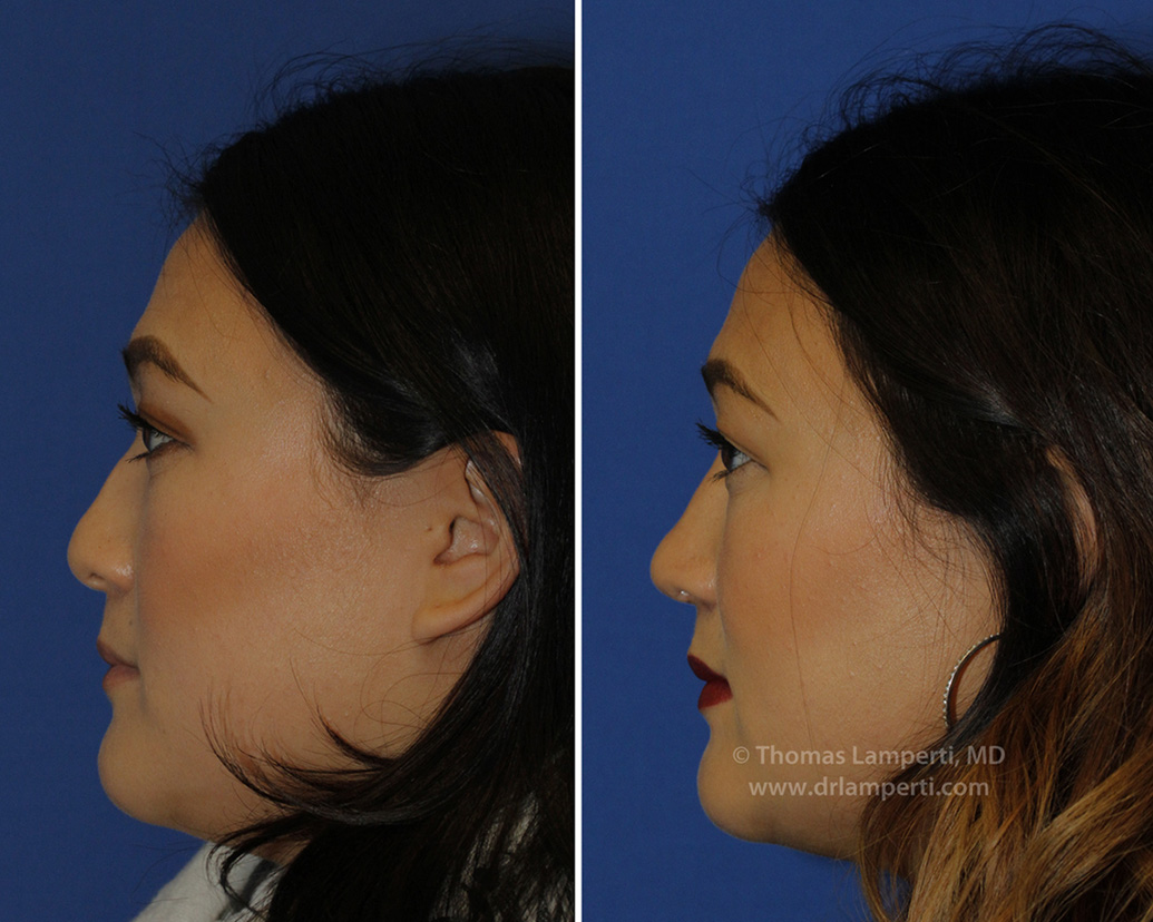 Patient 47 before and after under-projected tip rhinoplasty