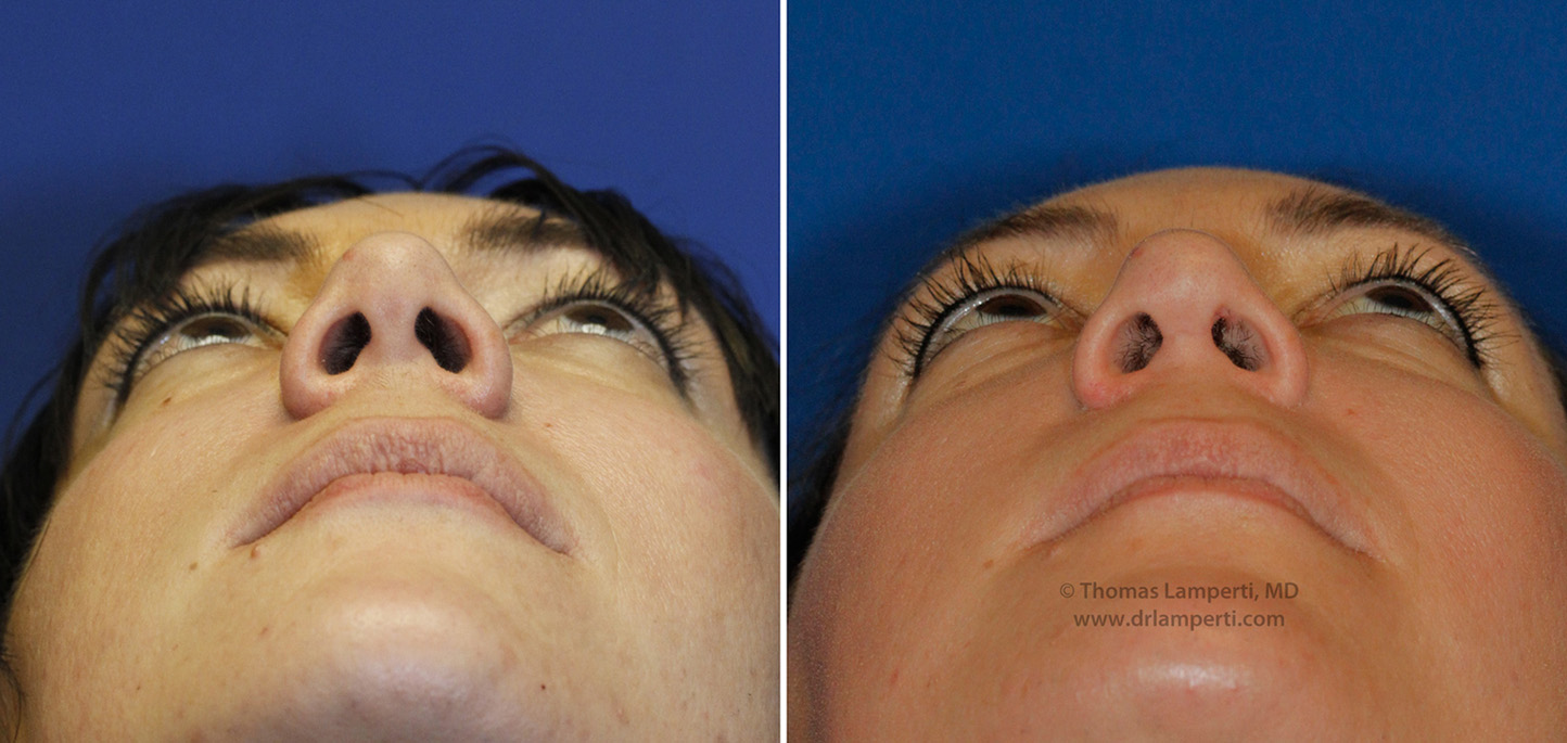 rhinoplasty-patient-46-nostril reduction photo