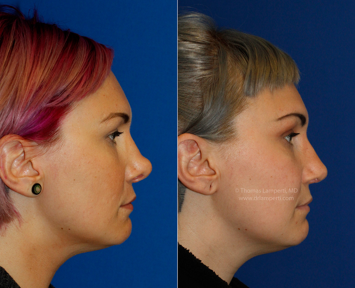 Revision rhinoplasty patient 14 profile montage before and after photos