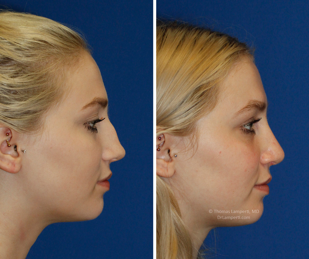 PHOTOS: Before and After Saddlenose and Bridge Hump Rhinoplasty ...