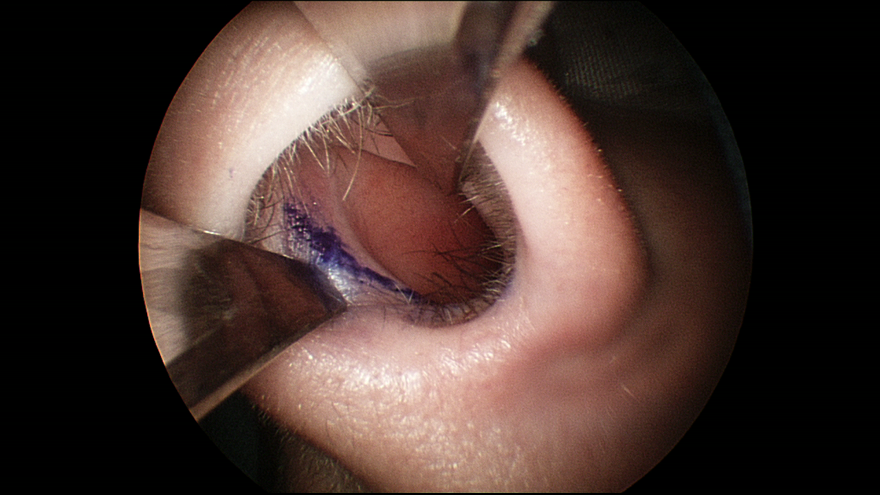 Septoplasty incision placement shown just inside the left nostril