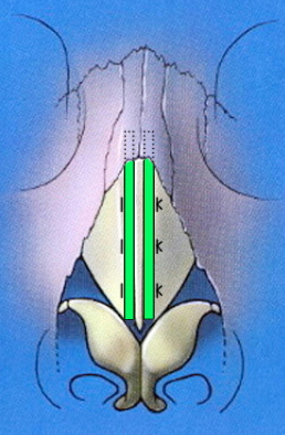 Frontal schematic of spreader grafts