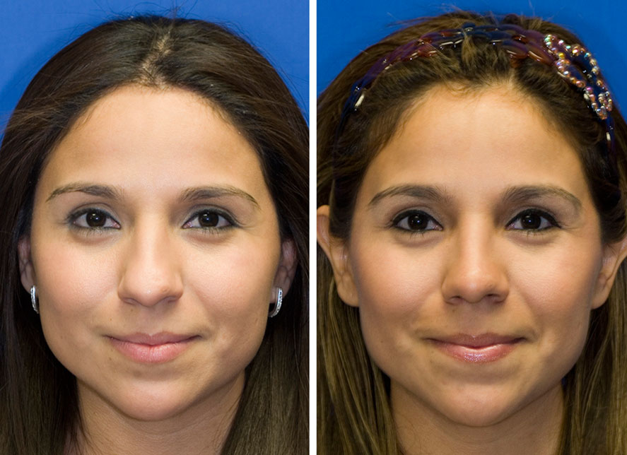Hispanic bulbous tip rhinoplasty frontal before and after