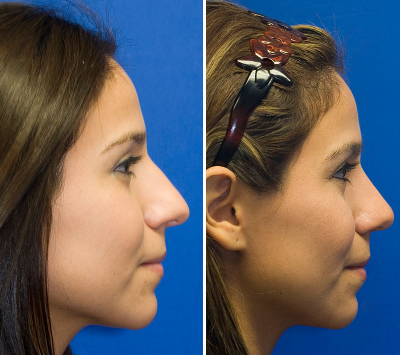 Hispanic female showing bulbous nose repair, bridge refinement and tip deprojection