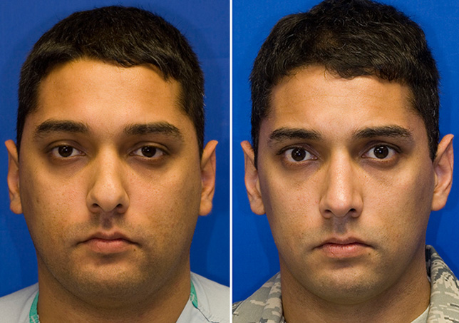 Hispanic male rhinoplasty to decrease tip bulbosity