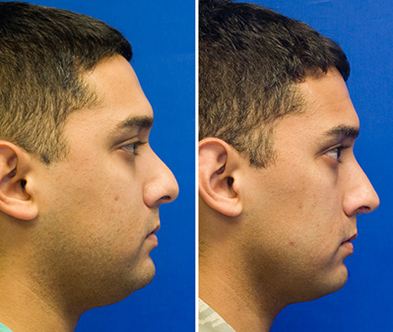 Under-projected tip and hump reduction rhinoplasty