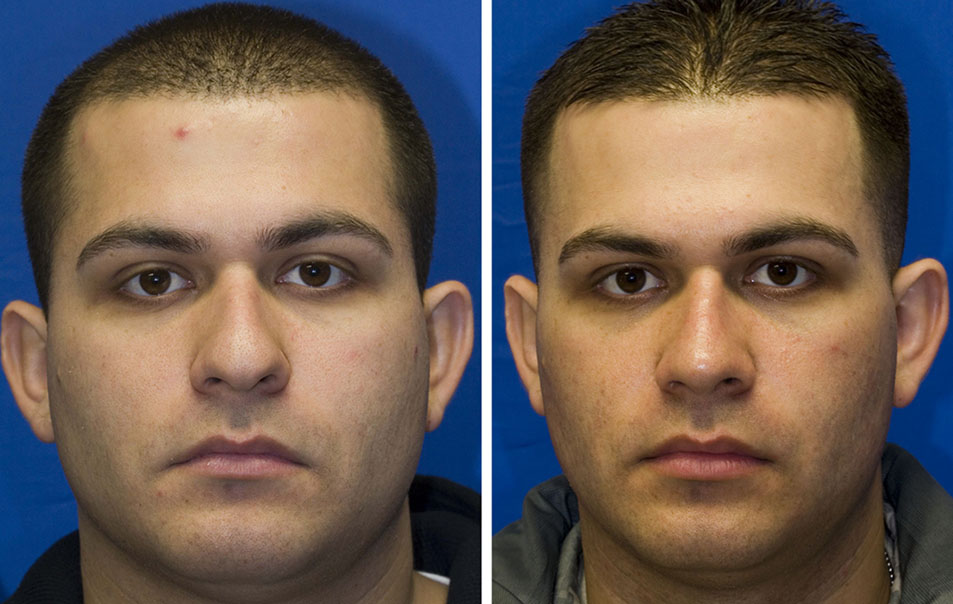 Hispanic male rhinoplasty before and after