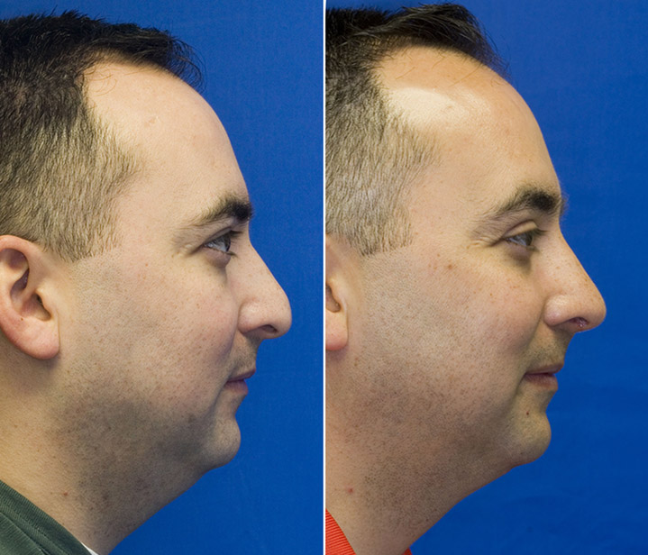 Under-projected nose | Rhinoplasty in Seattle | Rhinoplasty Surgeon