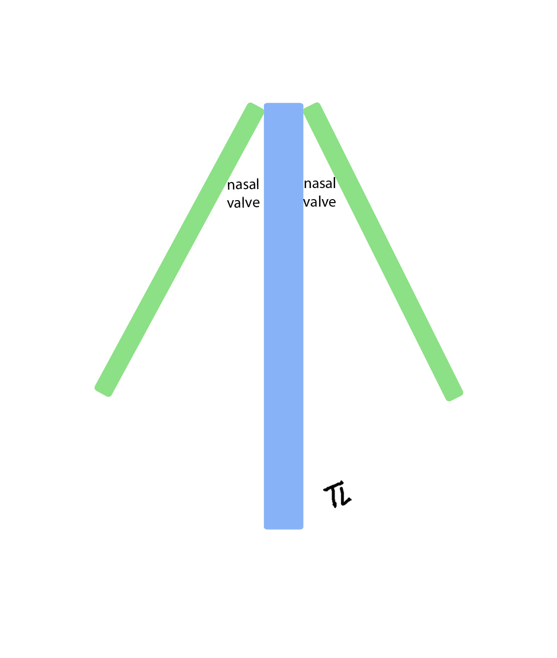 Upper lateral cartilage and septum cross section schematic showing internal nasal valve