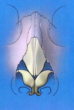 Collapsed upper lateral cartilages schematic