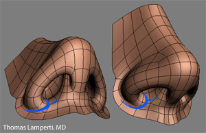 Wide Nostrils And Tip Rhinoplasty In Seattle Rhinoplasty Surgeon